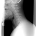 cervical spine, xray, patient-1129431.jpg